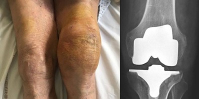 Клинический случай: фаготерапия рецидивирующей инфекции протеза коленного сустава